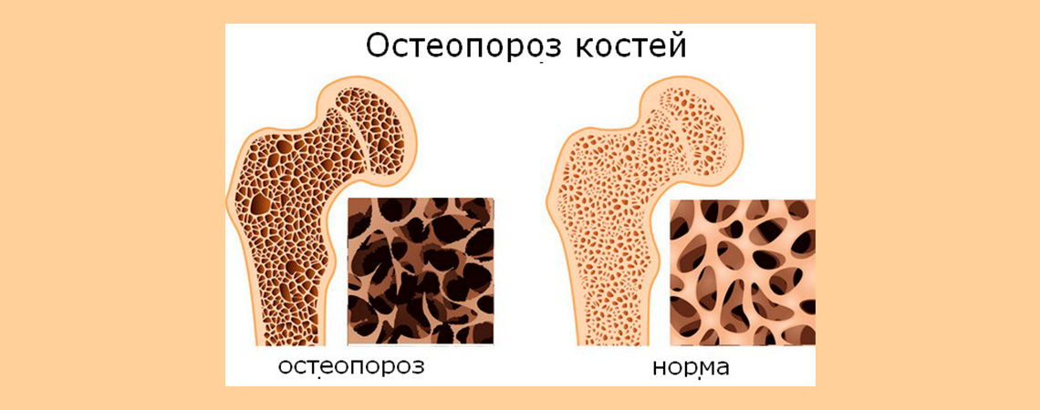 Остеопороз