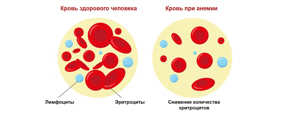Об анемии